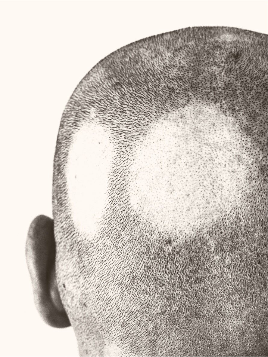 Patient with alopecia areata, or bald patches on the back of the scalp