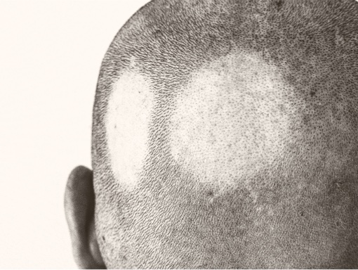 Patient with alopecia areata, or bald patches on the back of the scalp