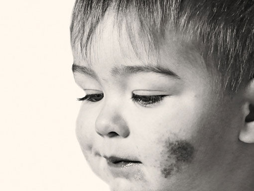 Child with atopic dermatitis slightly smiling