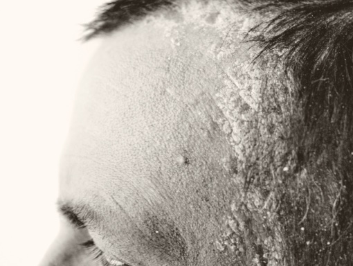 Man with scalp psoriasis at hairline