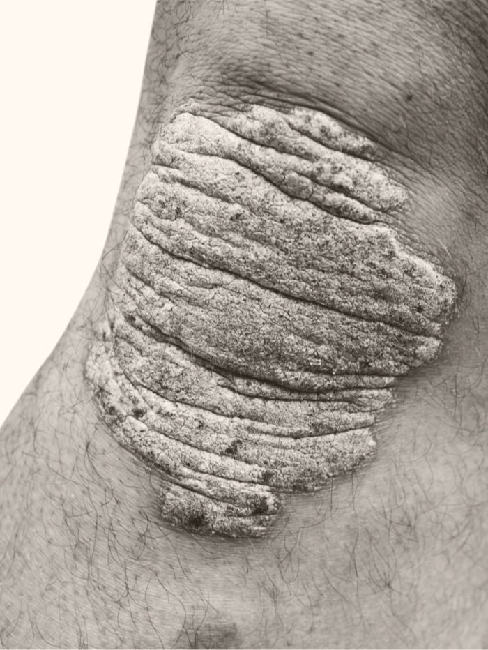 Patient with plaque psoriasis on knee