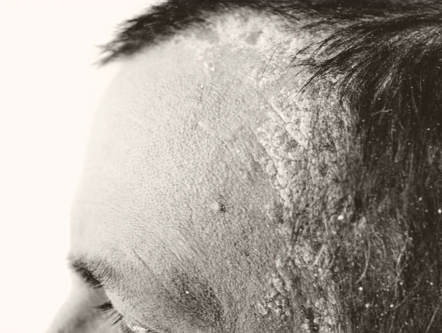 Man with scalp psoriasis at hairline