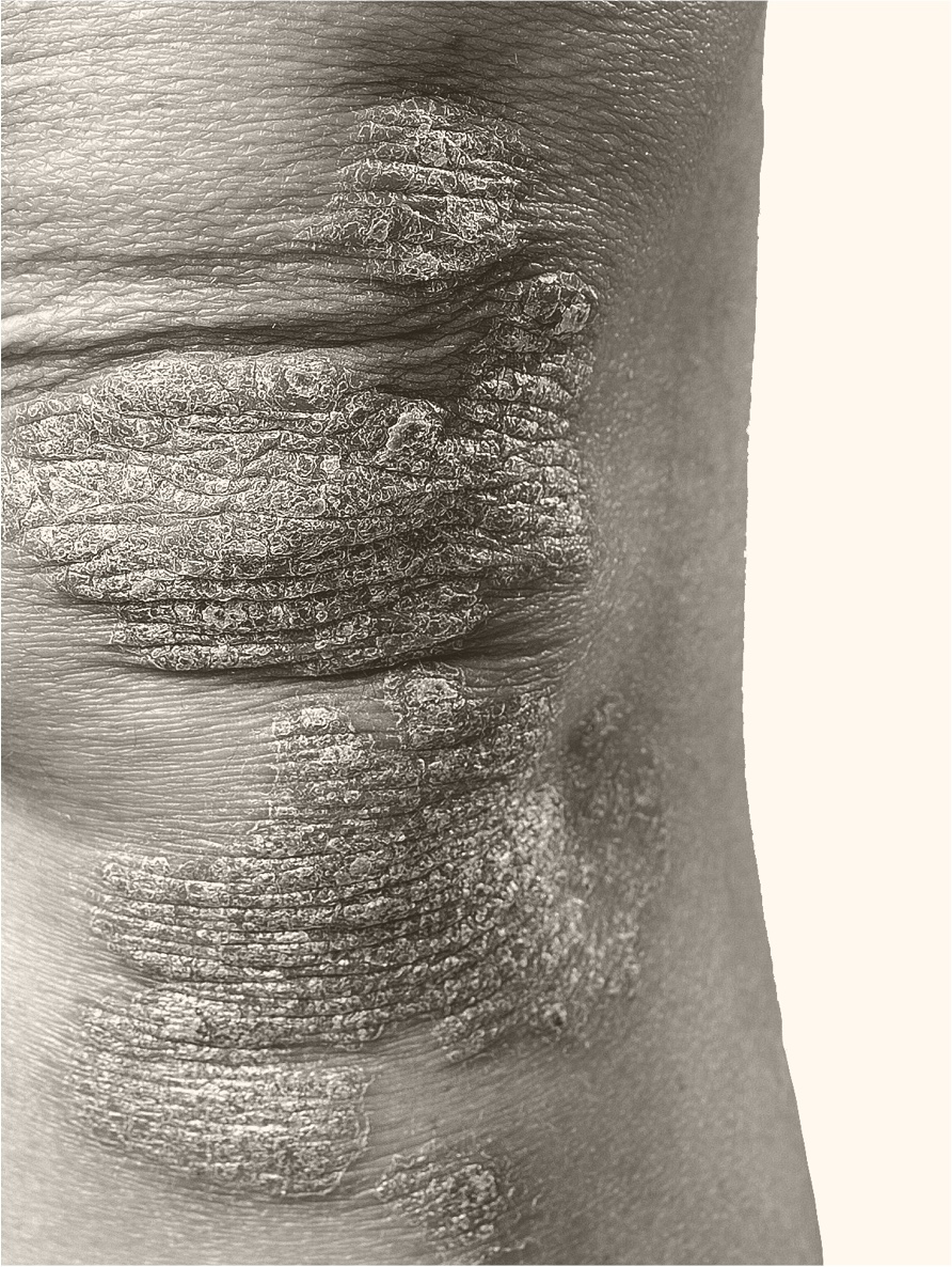 Patient with plaque psoriasis on knees