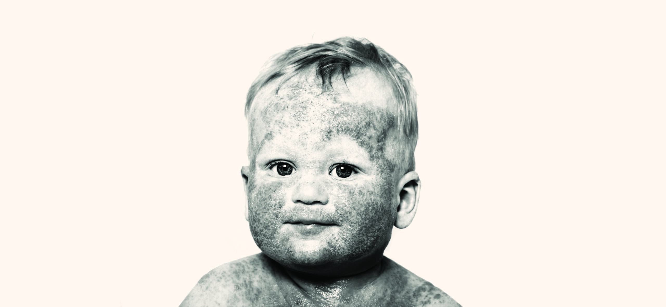 Little baby with dermatitis on face